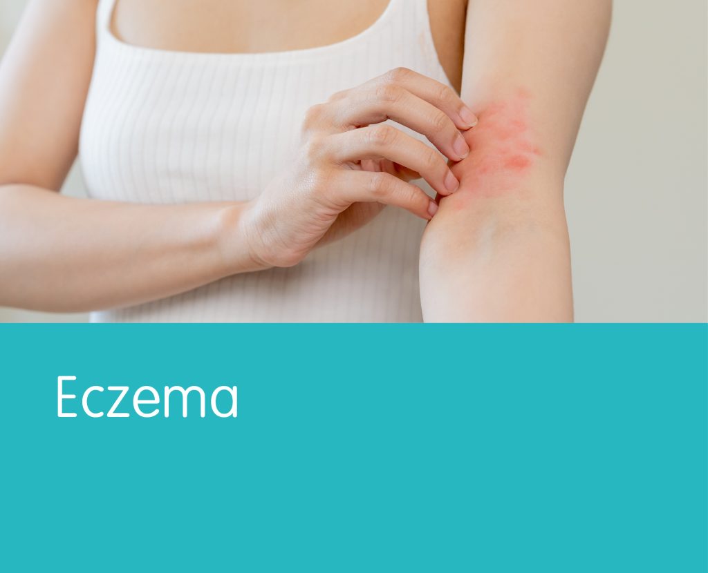 Eczema - YLP